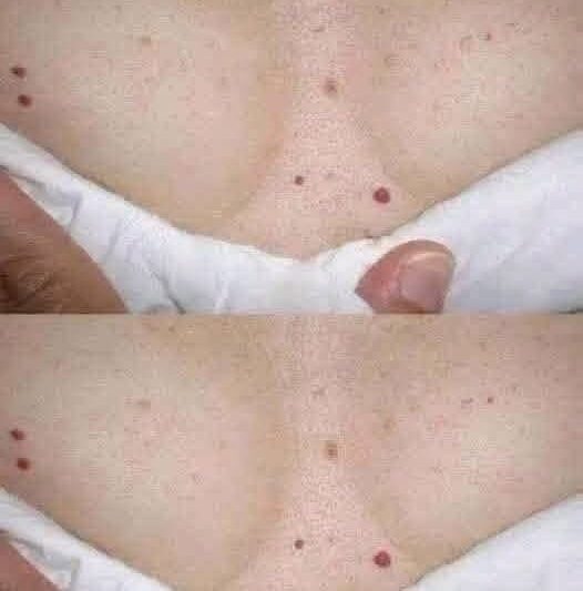 puntos rojos en la piel que recuerdan visualmente a los lunares es una